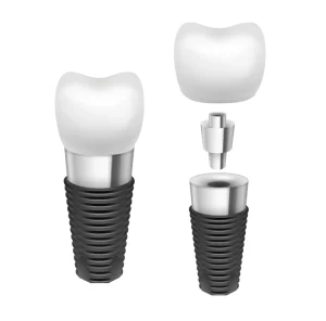 Does Dental Insurance Cover Implants in Phoenix, Arizona