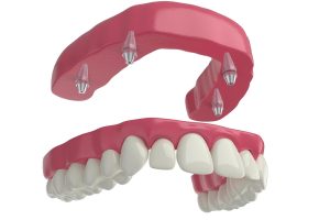 About Phoenix All-on-4 Dental Implants