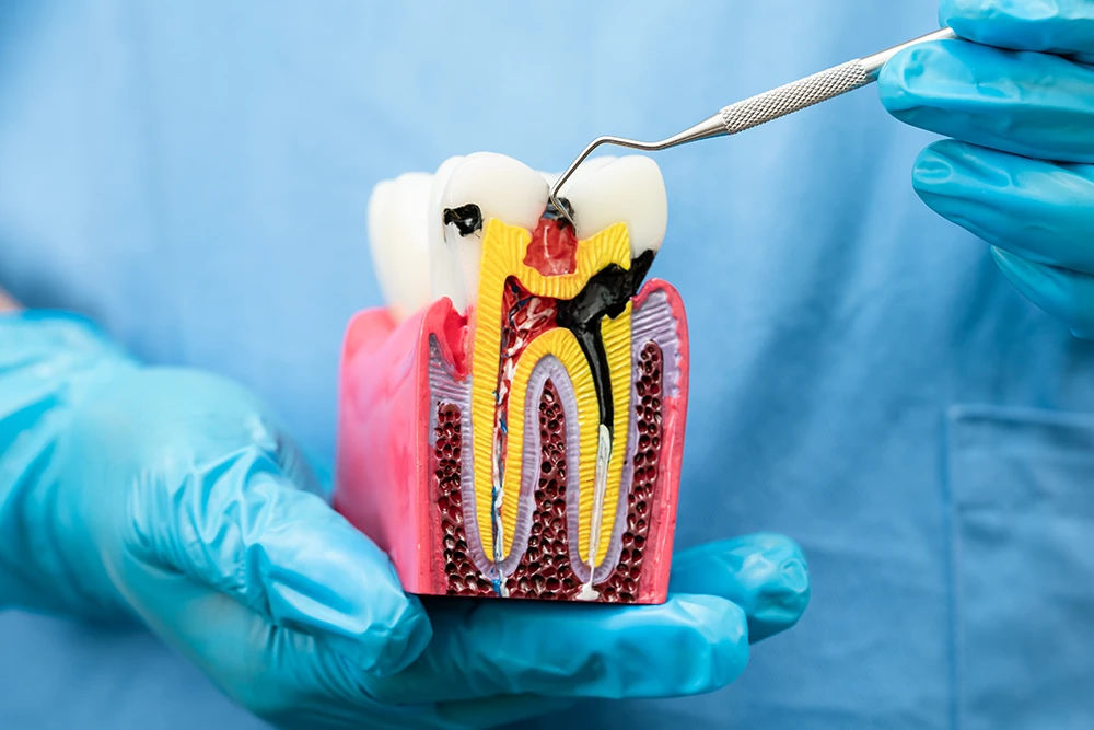 Symptoms: You Have a Cavity and Need Dental Fillings