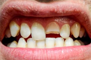 The Best Ways To Deal With Discolored, Crooked Or Missing Teeth