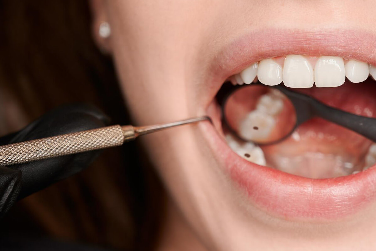 How to Tell If You Have a Cavity