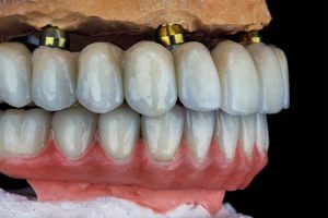 How Long Do All-on-4 Implants Last