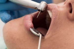 When Can I Eat After a Tooth Filling