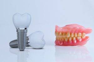 Dental Implants vs. Dentures: How to Choose?