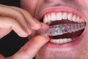 How Long Does Invisalign Take from Start to Finish?
