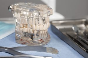6 Best Multiple Teeth Replacement Options