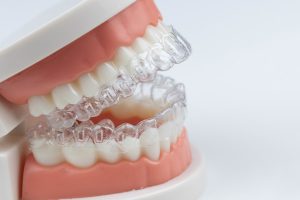 Can Invisalign Cause Root Resorption?