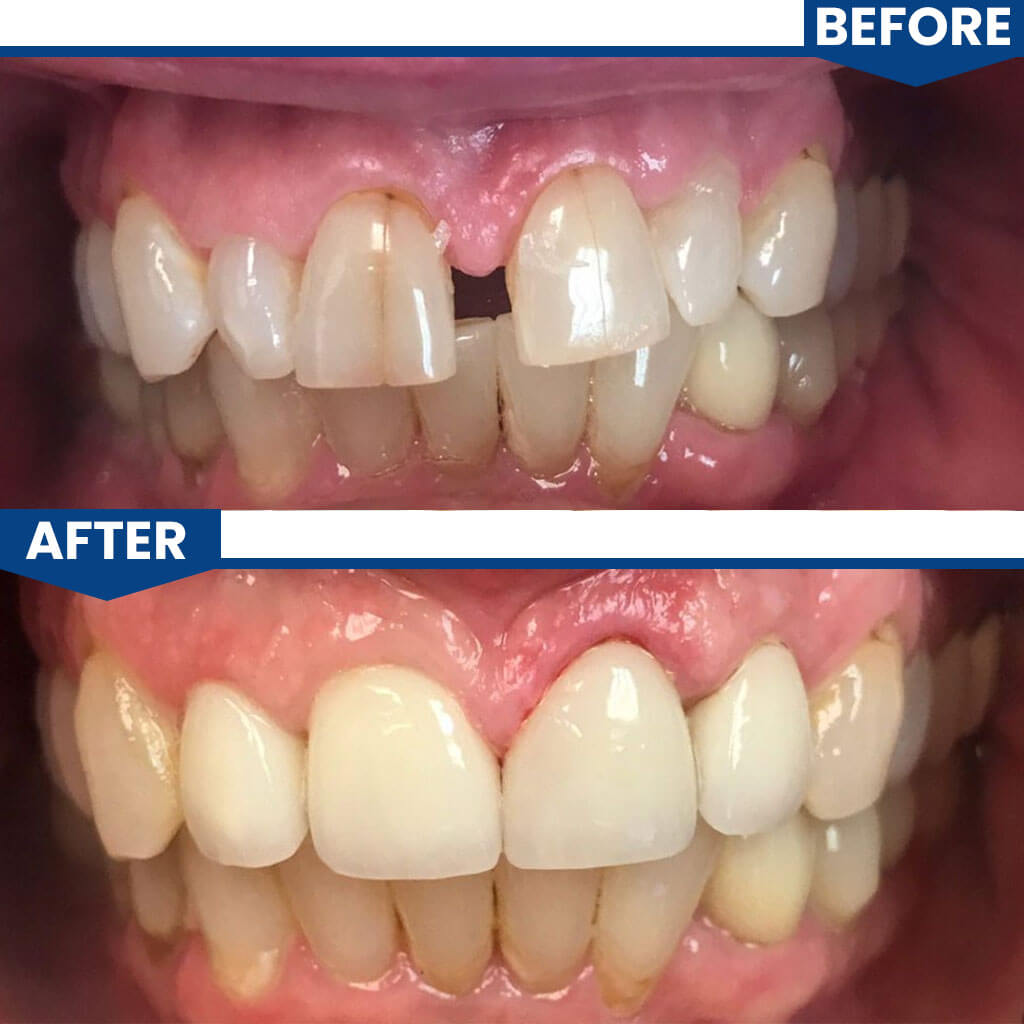 Before and After All on 4 Dental Implants