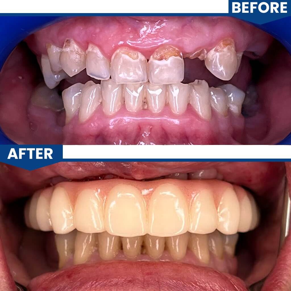 Before and After All on 4 Dental Implants
