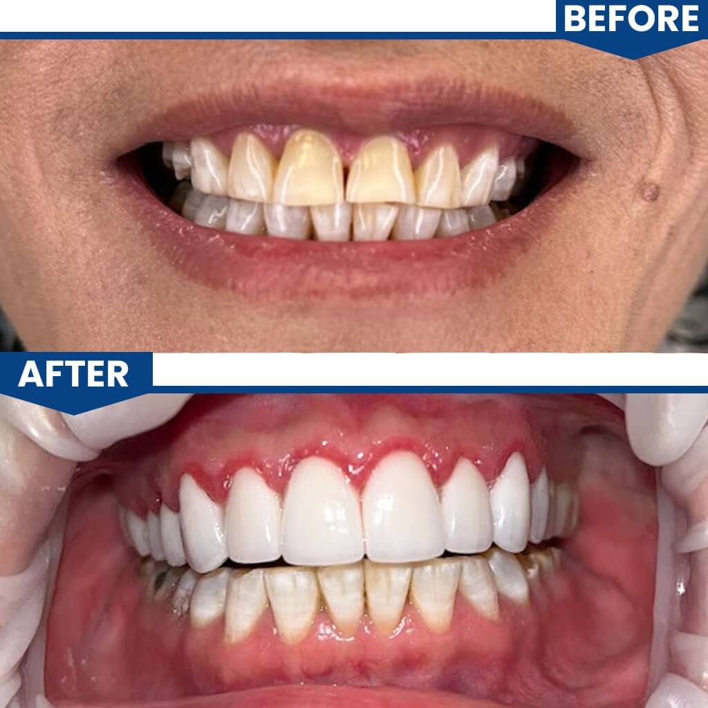 Before and After All on 4 Dental Implants