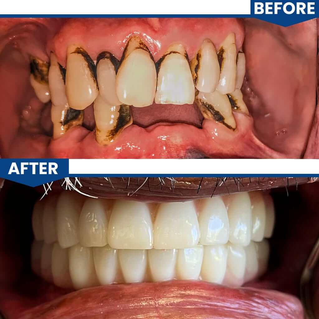 Before and After All on 4 Dental Implants