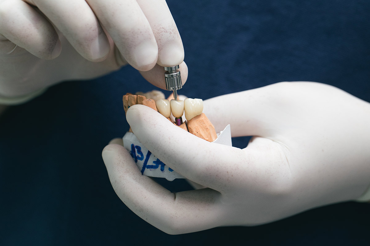 5 Steps of Dental Implant Restoration