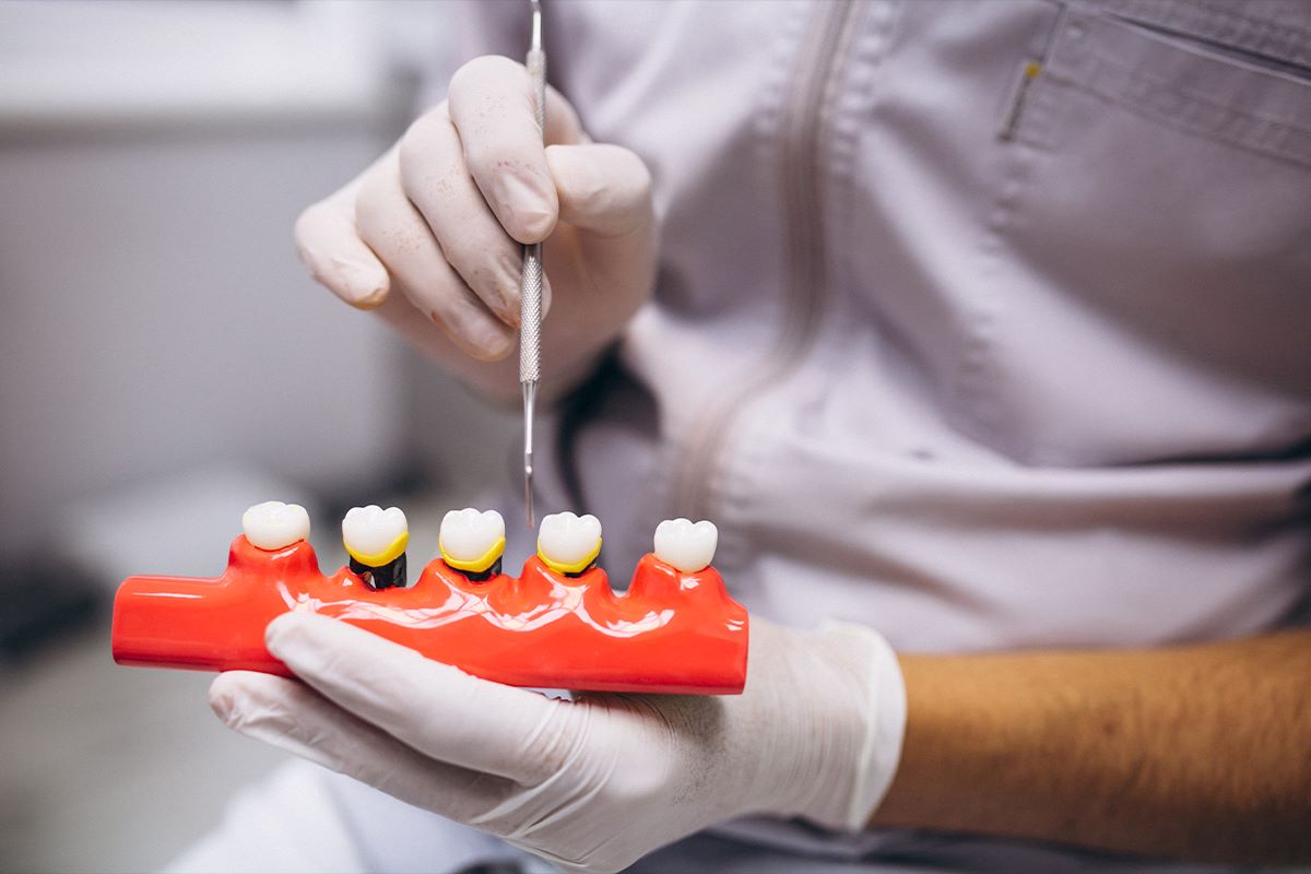 7 Differences Between a Dental Implant and a Crown