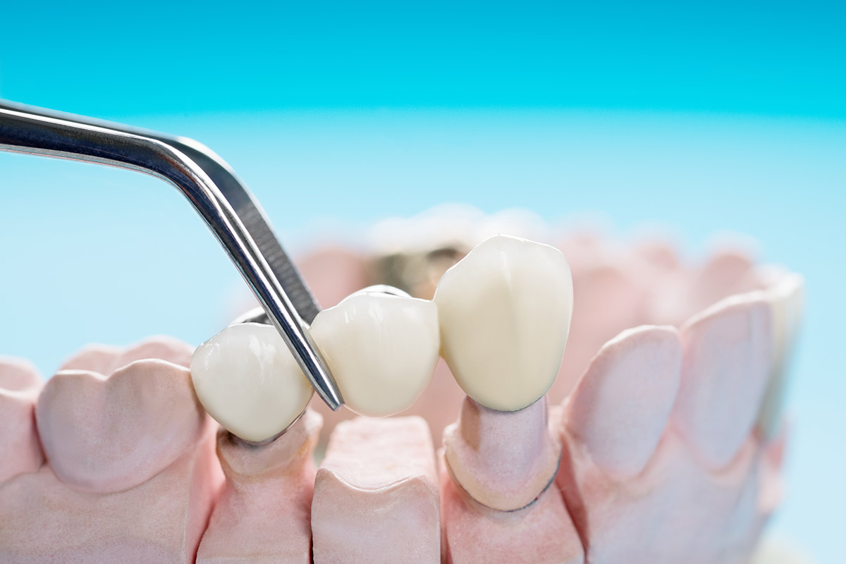 Can a Dental Bridge Be Removed and Re-cemented?