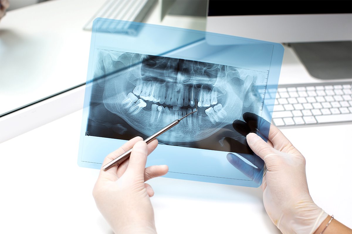 Full Mouth Reconstruction Process Step-By-Step