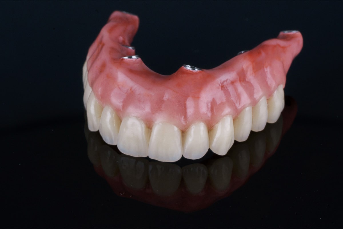 5 Differences Between Snap-on Dentures and All-on-4