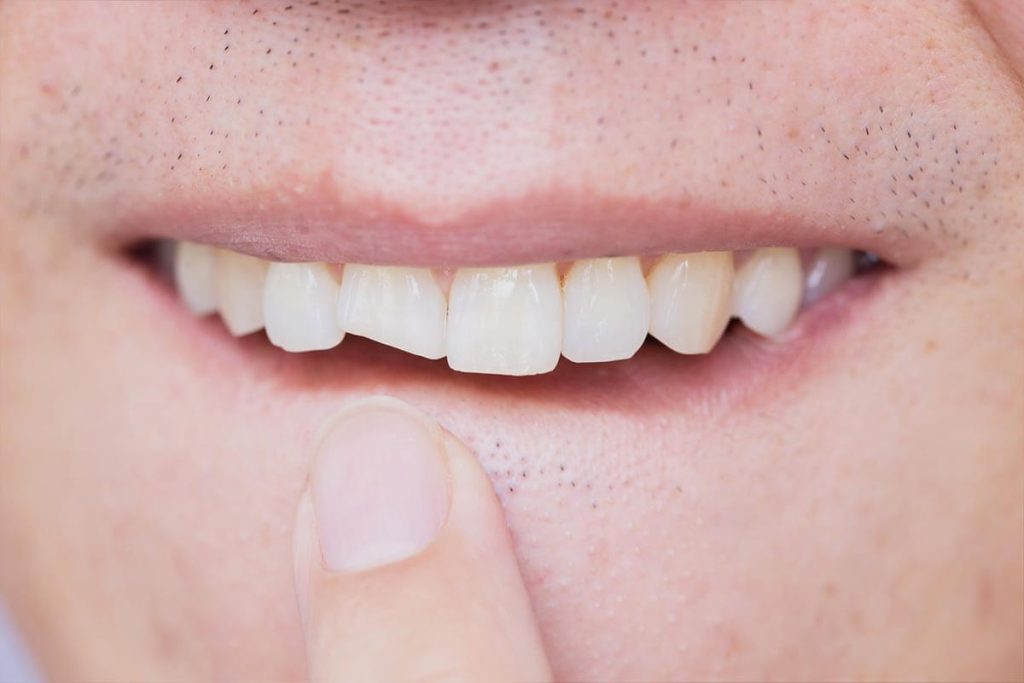 How Long Can a Broken Tooth Go Untreated?