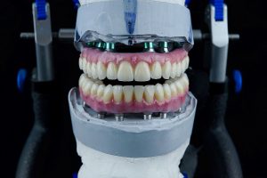What Are the Differences Between All-on-4 and Overdenture?