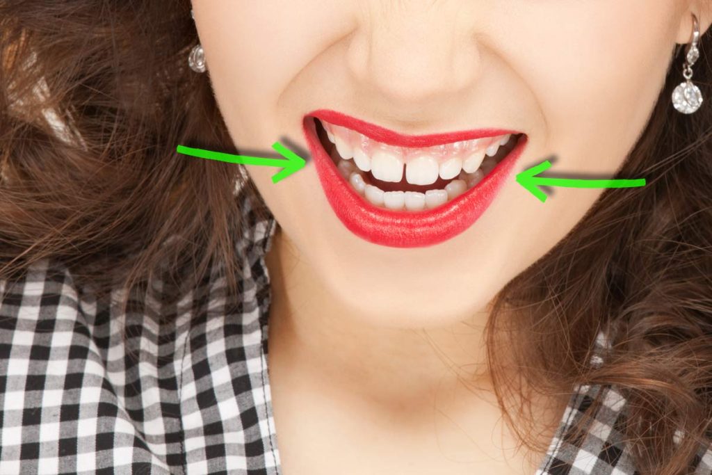 4 Ways To Fix Gaps Between Teeth