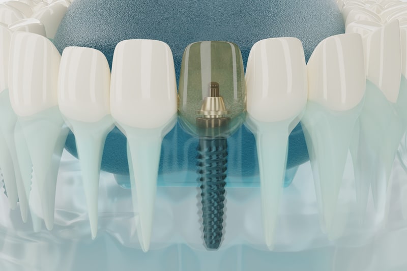 Single Tooth Implant Phoenix
