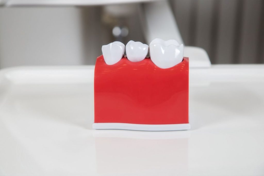 Will Gum Grow Around Implant Crown?
