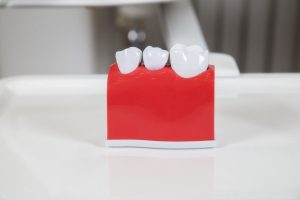 Will Gum Grow Around Implant Crown?