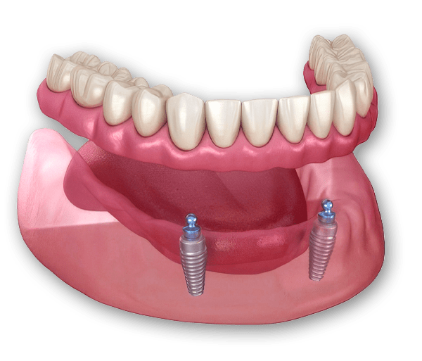 Snap-in Denture