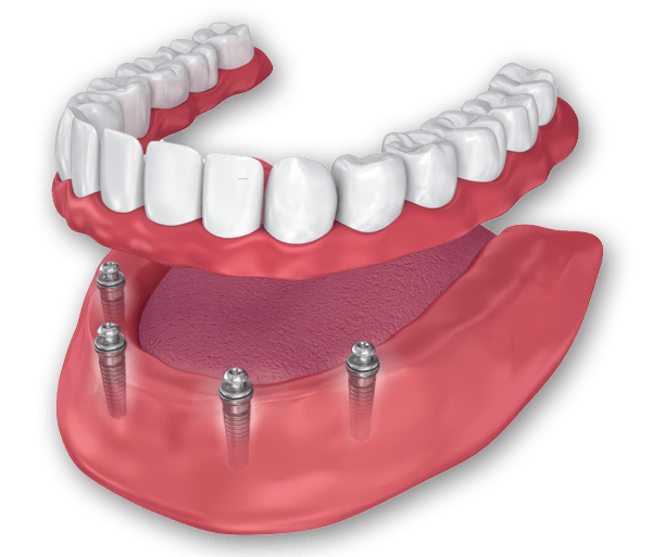 Affordable Permanent Single Arch (All-On-4)