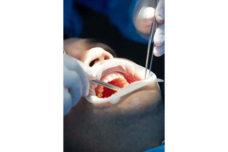 Root Canal Treatment Cost in Phoenix