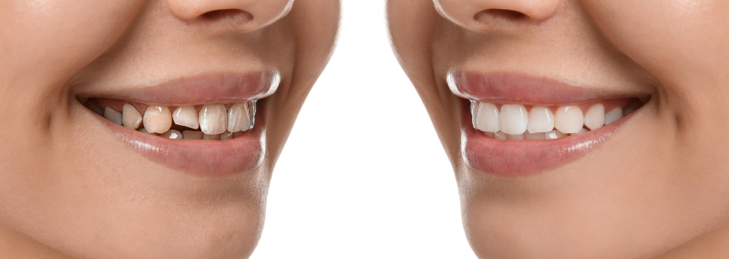 Teeth Bonding Before After