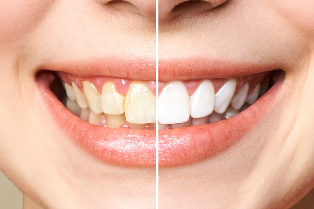 before and after teeth whitening Phoenix Arizona