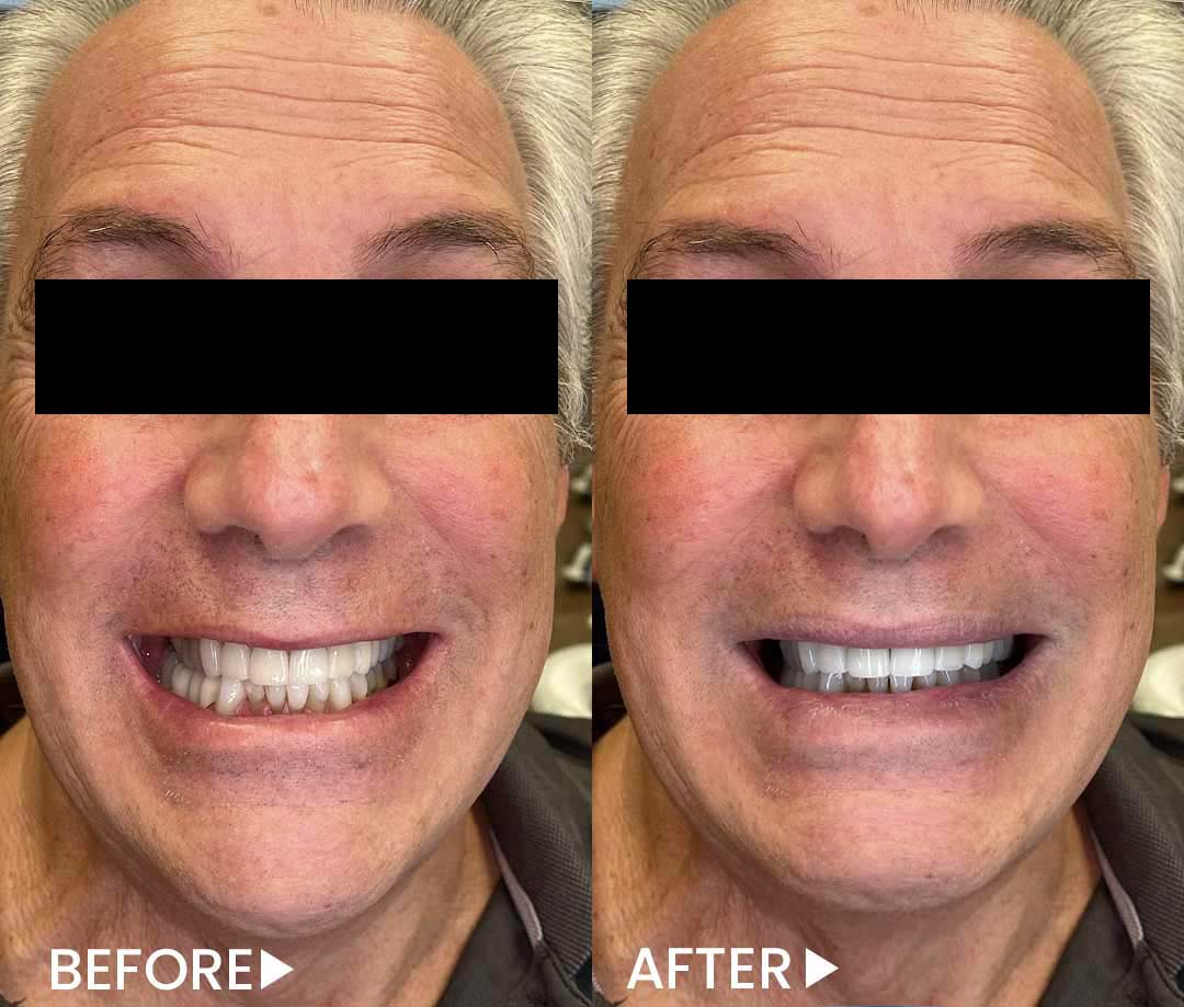 All-on-4 - Implants - Before After