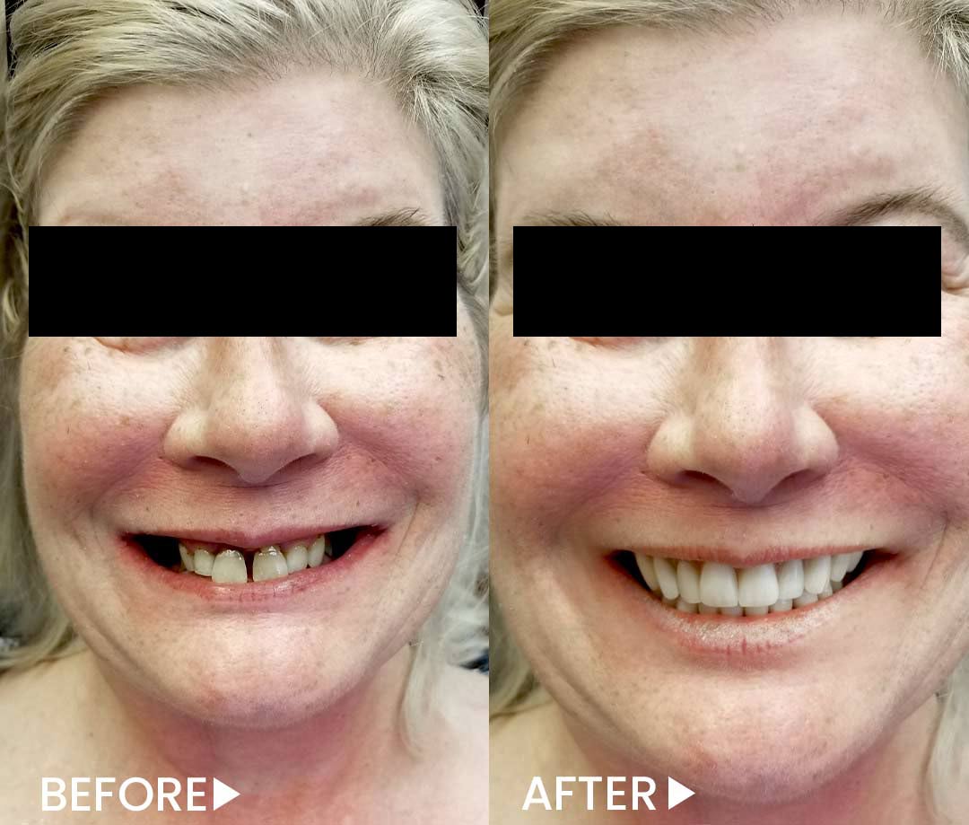 All-on-4 - Implants - Before After