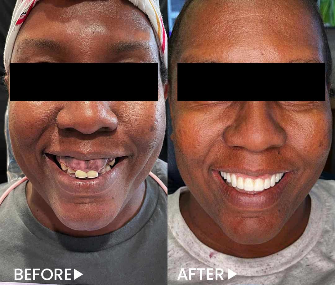 All-on-4 - Implants - Before After