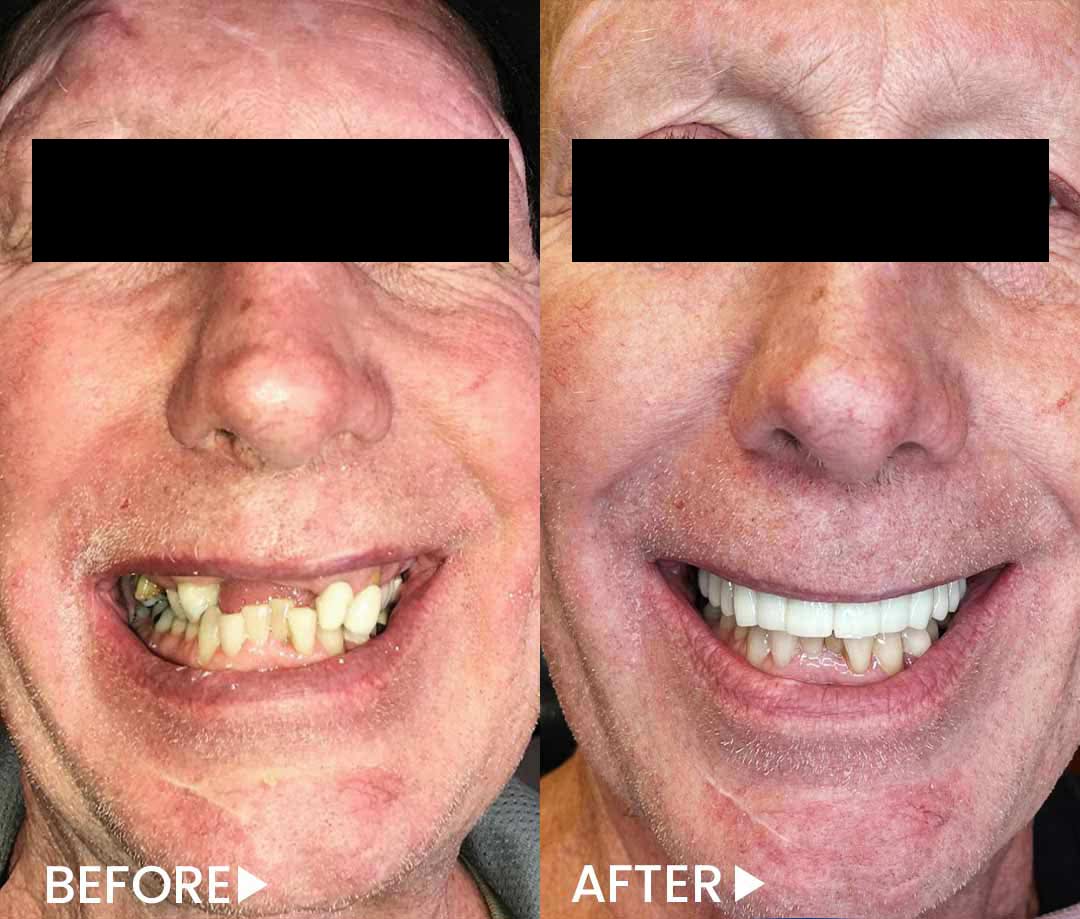 All-on-4 - Implants - Before After