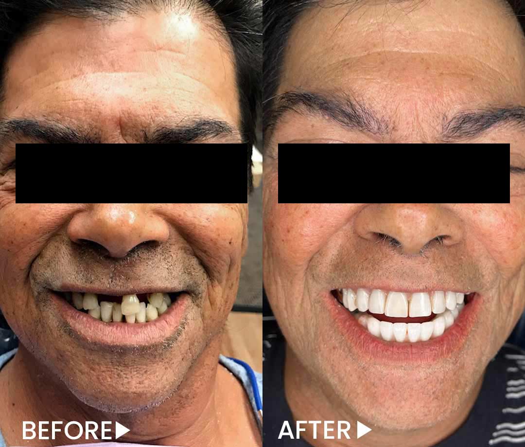 All-on-4 - Implants - Before After