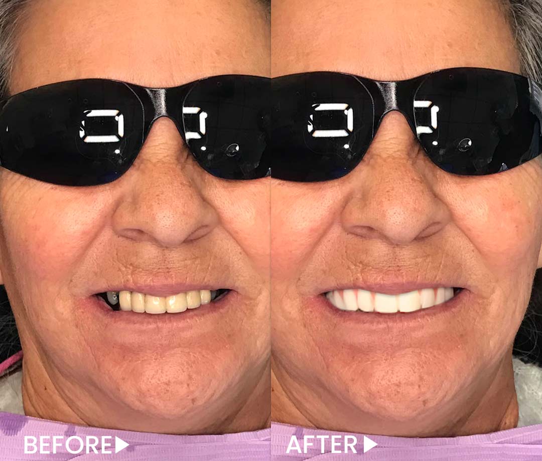 All-on-4 - Implants - Before After