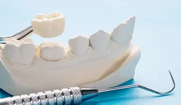 Same Day CEREC Crowns Phoenix