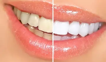Teeth whitening Phoenix-AZ