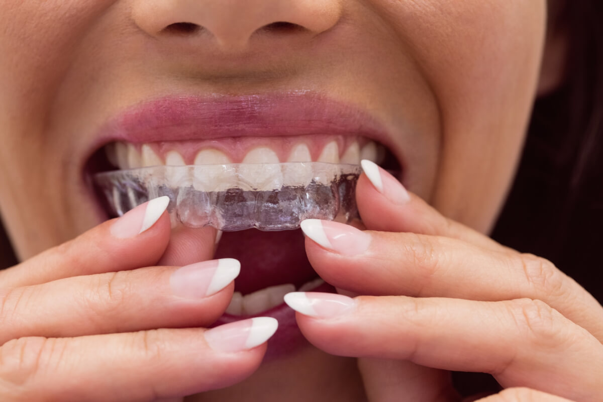 How Much Do Clear Aligners Cost in Phoenix