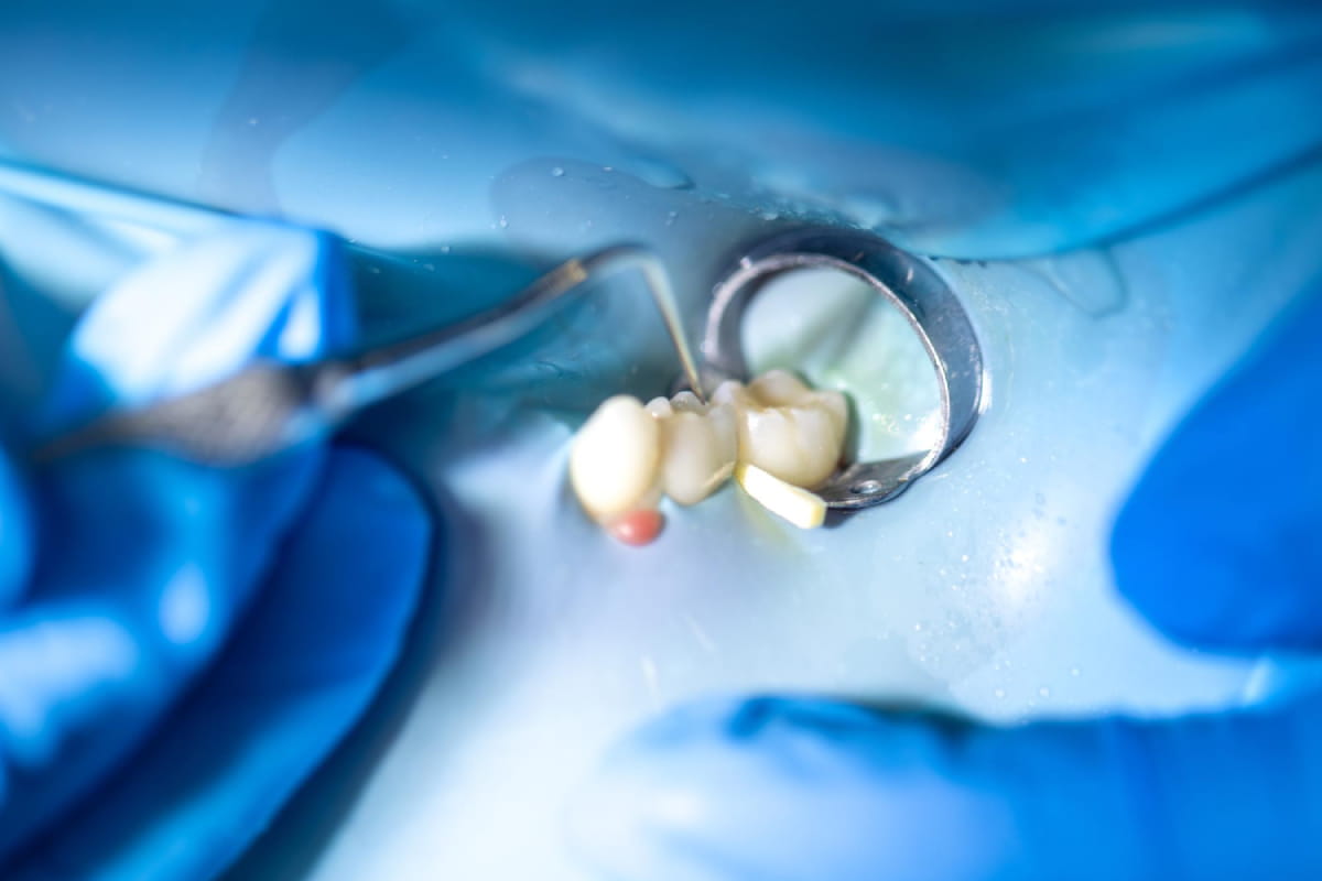 How Long Does a Dental Filling Last?