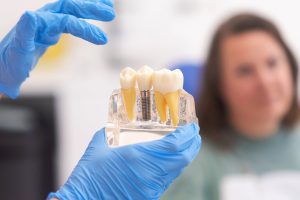 What is a Screwless Dental Implant