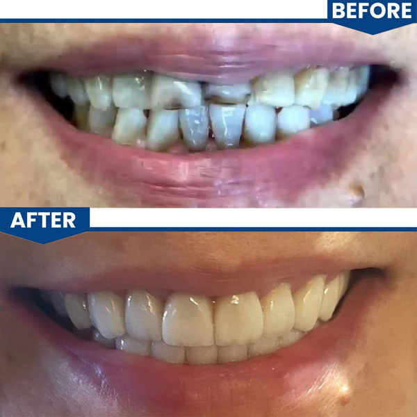 Full mouth reconstruction w upper and lower crowns and implants w t-scan to balance bite