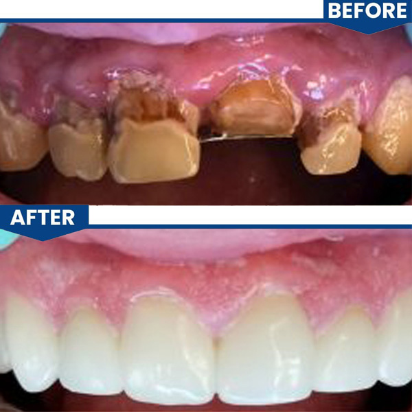 Procedures Root Canals, Same Day Crowns, & Full Upper Rehab