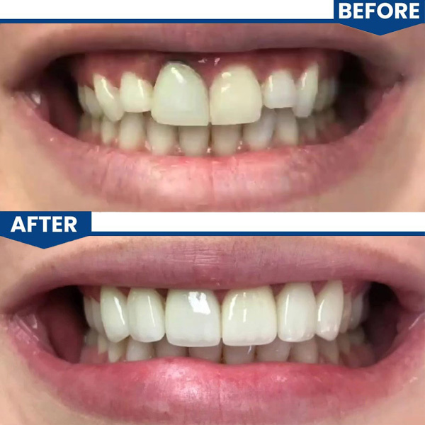 Upper anterior veneers
