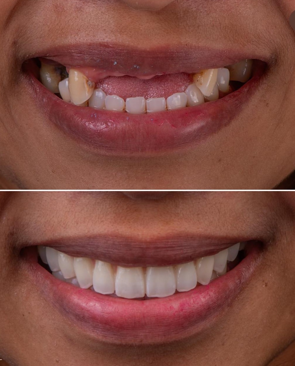 Before and after dental transformation