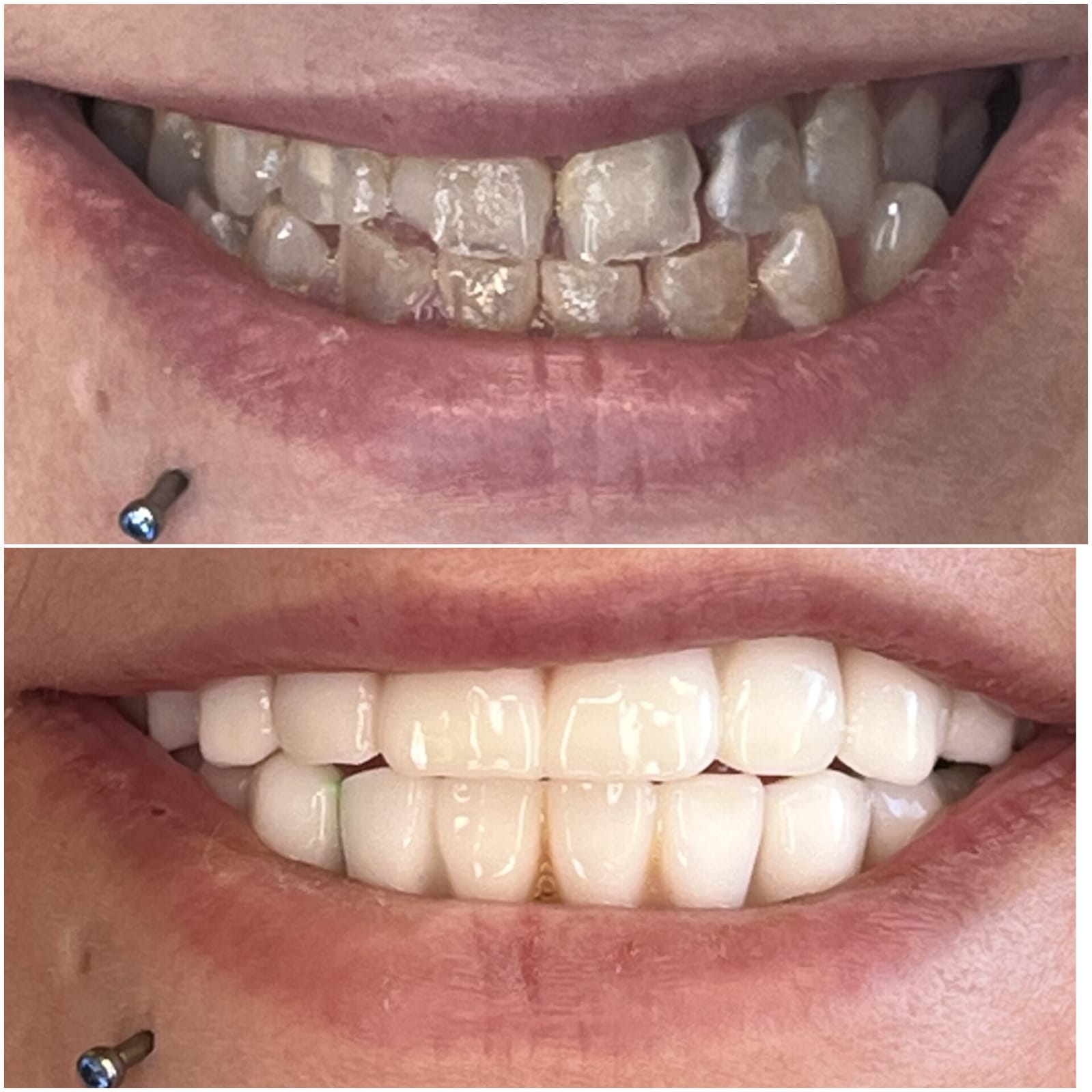 Before and after dental transformation